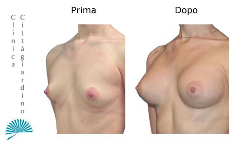 Correzione inestetismo al seno: prima e dopo intervento di mastoplastica