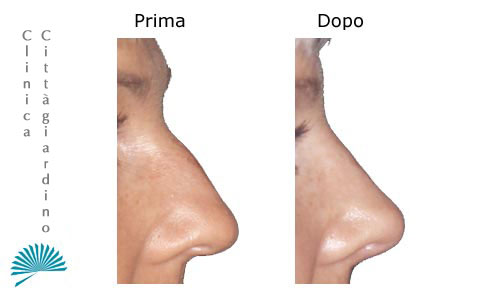 Correzione inestetismo al naso: prima e dopo intervento di rinoplastica